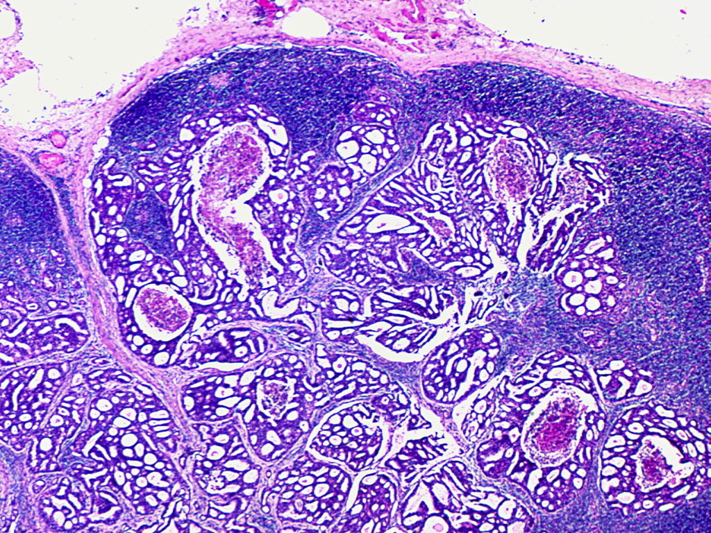 metastatic-carcinoma-lymph-node