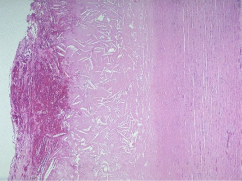 coronary-artery-disease