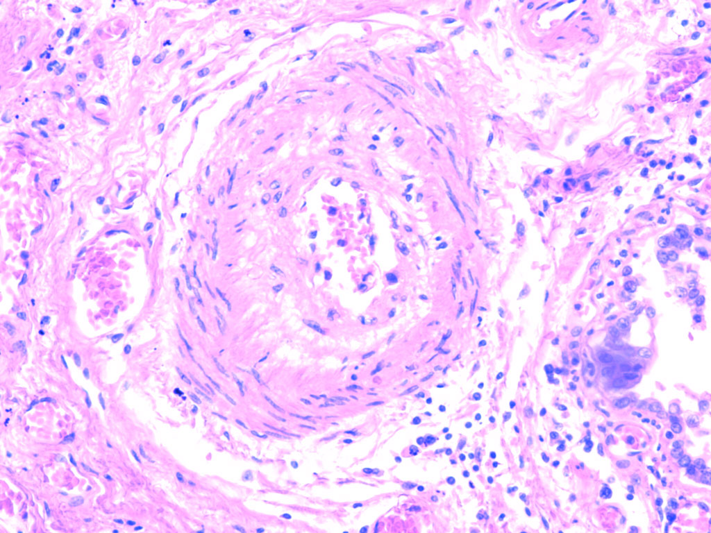 pulmonary-hypertension